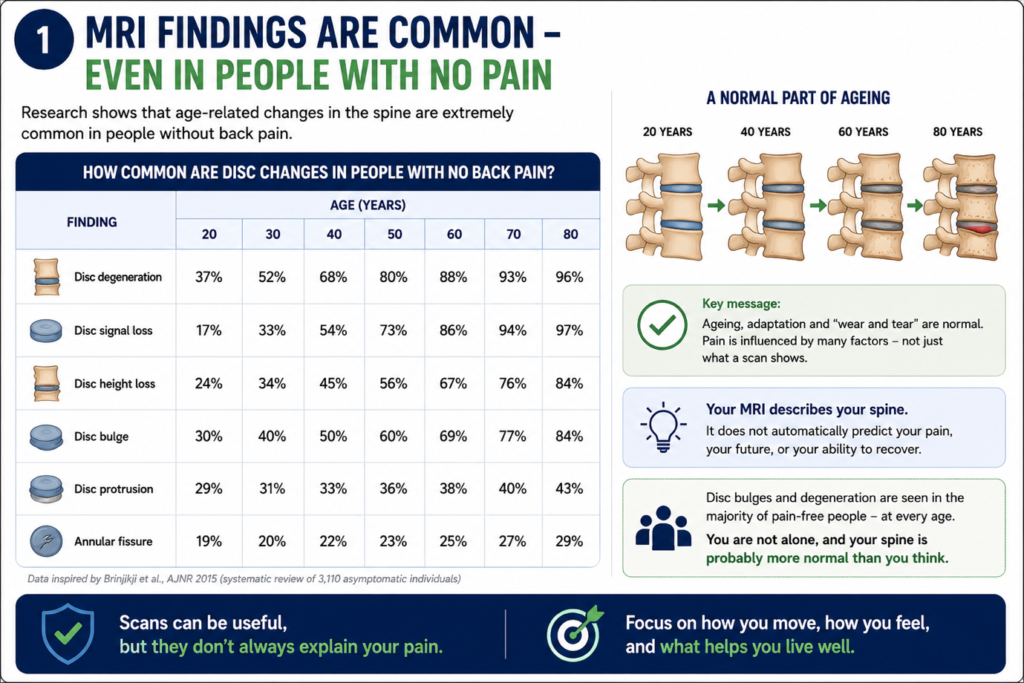 Infographic showing how common MRI findings such as disc bulges, disc degeneration and disc protrusions are in people without back pain across different age groups.