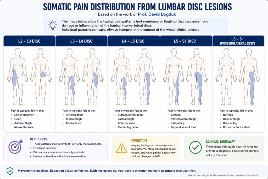 Infographic showing typical pain referral patterns from lumbar disc lesions at different spinal levels, illustrating how disc-related lower back pain can radiate into the buttock and leg.